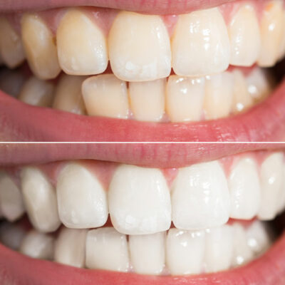 6 Ways to Naturally Whiten Teeth