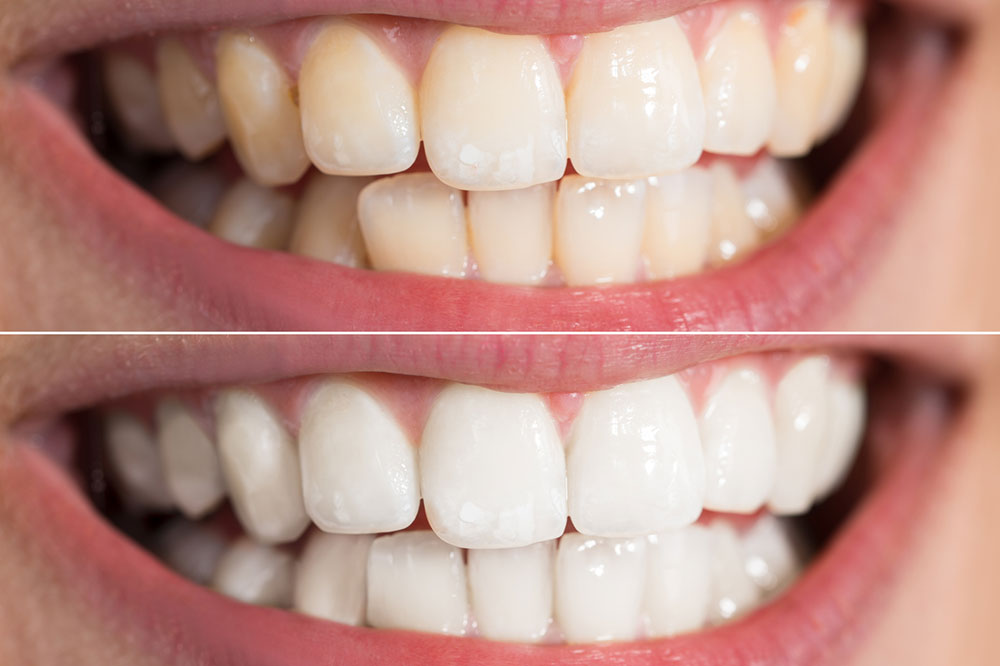 6 Ways to Naturally Whiten Teeth