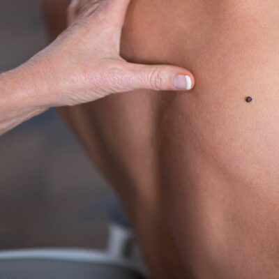 The Most Common Types of Melanoma