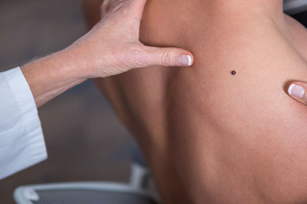 The Most Common Types of Melanoma